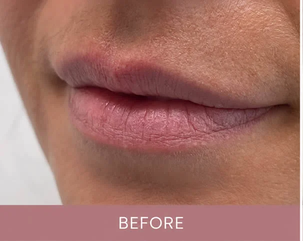 Lips before treatment