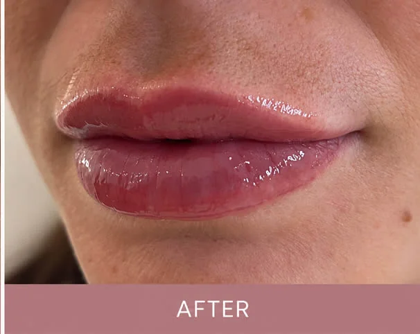 Lips after treatment