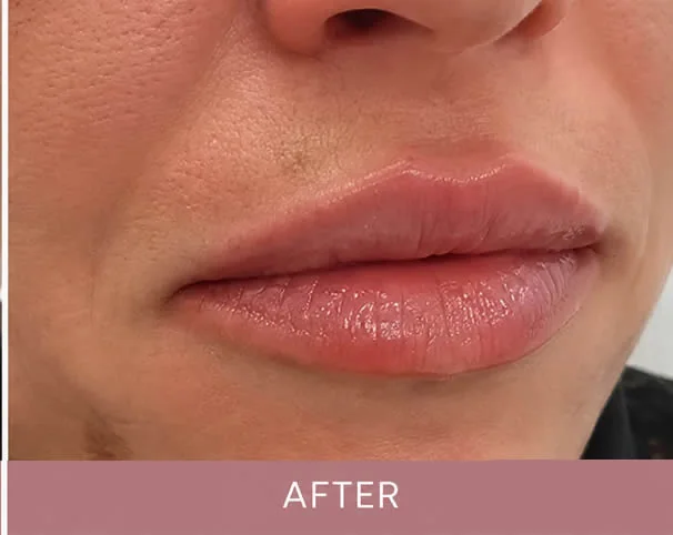Lips after treatment